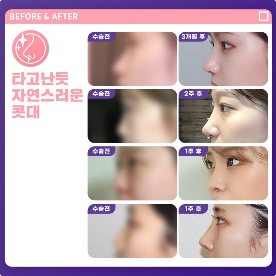 자가연골코성형, 제대로 따져보고 해야 하는 이유 관련 이미지 7