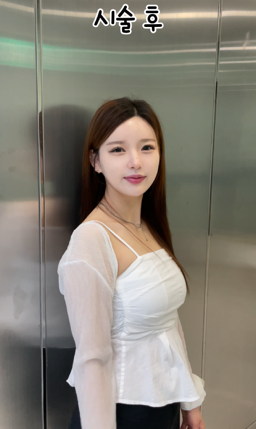 기린성형외과 쥬베룩볼륨 팔자주름, 앞볼, 관자 후기 관련 이미지 9