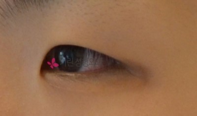 쌍꺼풀수술 전과 후 붓기비교(3달 반 경과) 관련 이미지 1