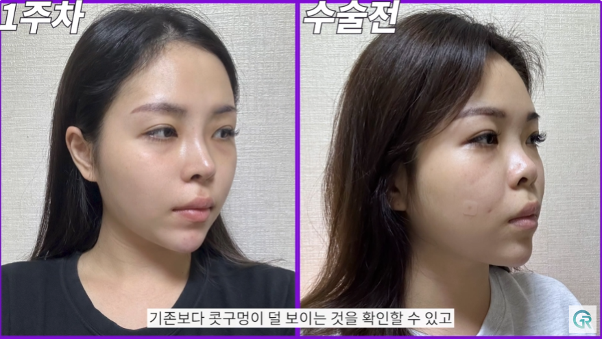 [기린성형외과] 짧고, 들린 코 탈출!_코성형 수술일지 관련 이미지 8