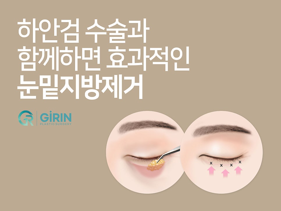 처진눈성형 다시 눈매를 잡아주며 관련 이미지 10