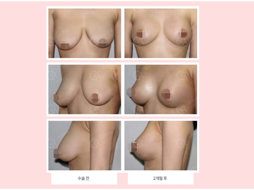 처진가슴성형 자신감 회복을 위해 관련 이미지 8