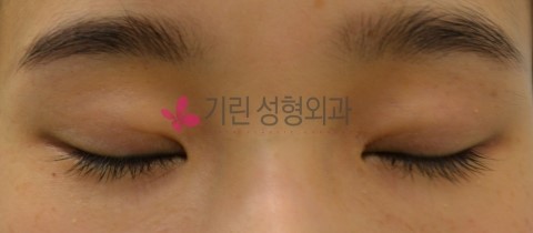 비절개눈매교정 흉터[수술후 3개월경과] 관련 이미지 2