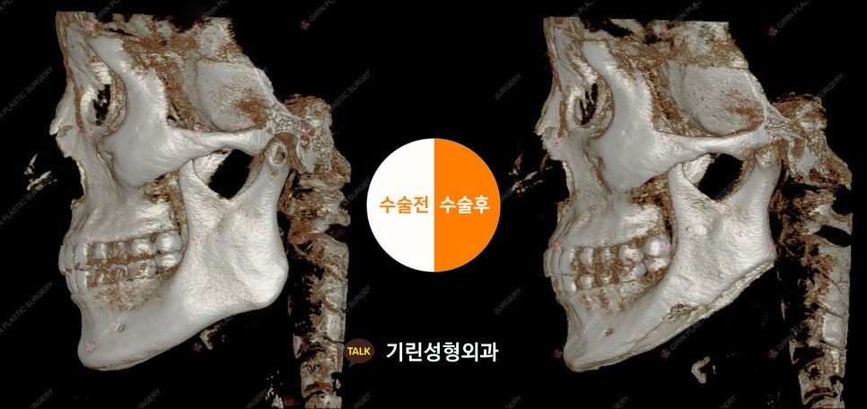 [뉴브이라인] 45도 라운딩 브이라인 절골술로 작은 얼굴 만들기 관련 이미지 11