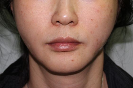 비수술 리프팅, 어떤 종류가 있을까? 관련 이미지 3