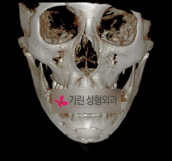 안면윤곽 후 이차각으로 인한 재수술 관련 이미지 2