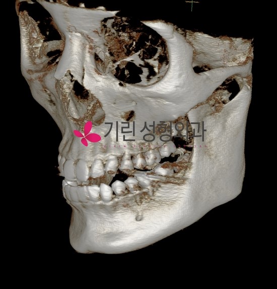 3DCT로 피질절골술 범위 확인방법 관련 이미지 1