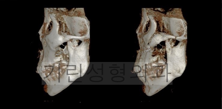광대뼈고정, 볼처짐 아큐스컬프 사례입니다. 관련 이미지 5