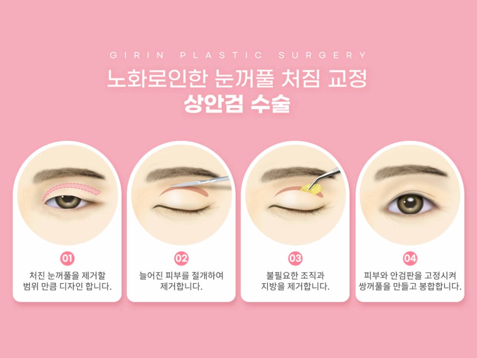 처진눈수술 눈매를 바꾸는 방법 관련 이미지 10