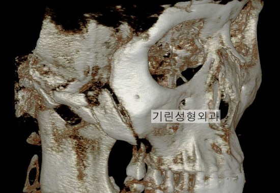 기린성형외과는 광대를 비고정으로 하나요 고정으로 하나요? 관련 이미지 1