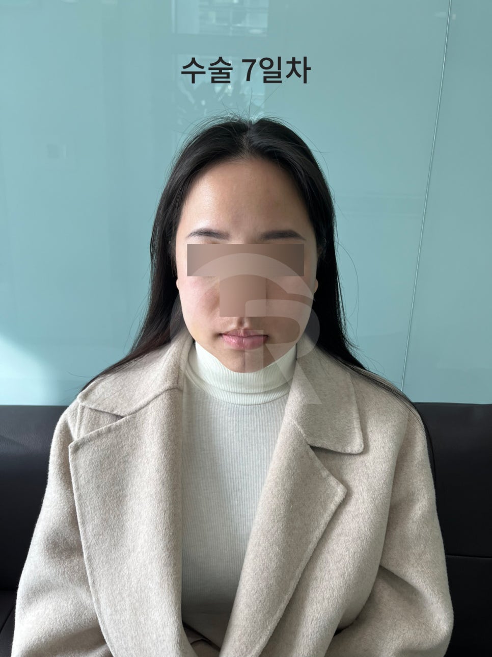 연조직윤곽술, 시간이 지날수록 자연스러운 얼굴선 관련 이미지 2
