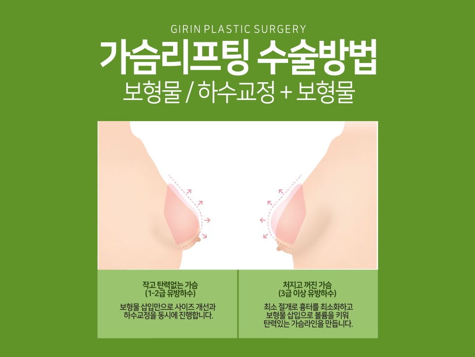 처진가슴수술후기 비교하며 선택한다면 관련 이미지 1