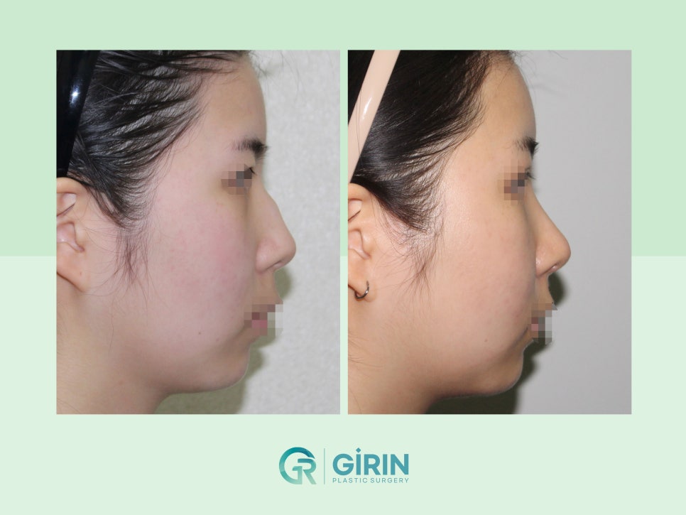 비염코성형 실비 가능성 있기에 관련 이미지 2