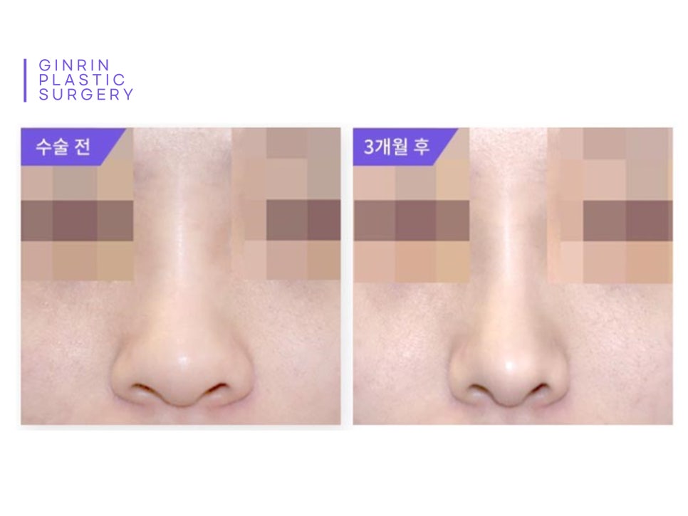 콧볼축소수술전후 얼마나 달라질까 관련 이미지 2