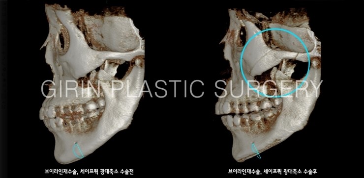 귀뒤사각턱 재수술사례 관련 이미지 3