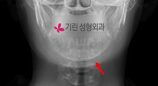 사각턱수술 후 어디까지 잘라냈는지 엑스레이를 보고 알 수 있을까? (피질골절제술 시행여부 판단방법) 관련 이미지 2