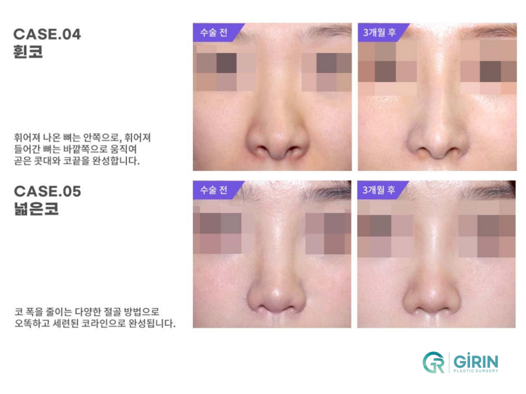 무보형물 코성형 안전하게 잘하는 곳 관련 이미지 10