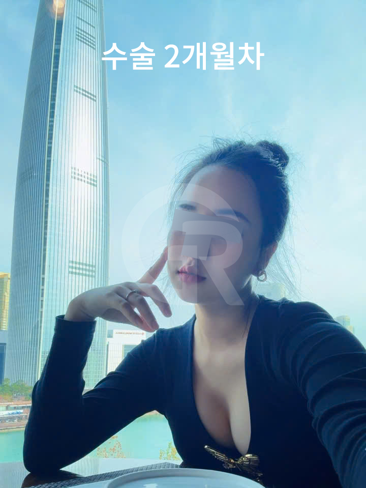 연조직윤곽술, 시간이 지날수록 자연스러운 얼굴선 관련 이미지 4