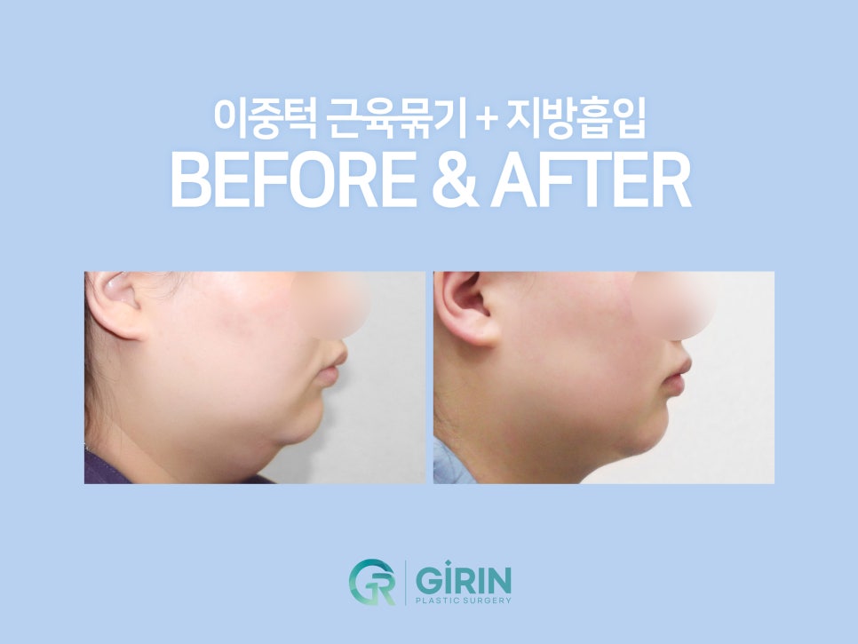 이중턱지방흡입 하나로 어렵다면? 관련 이미지 8