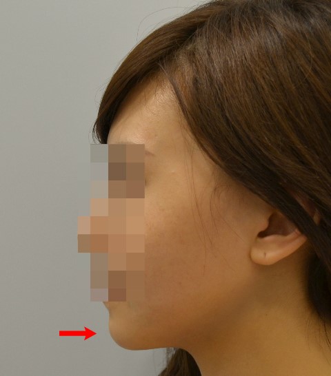 무턱을 앞턱보형물로 수술한 경우 (경미한 돌출입) 관련 이미지 2