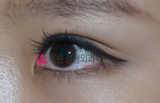 쌍꺼풀수술: 티안나는 쌍꺼풀수술 관련 이미지 3