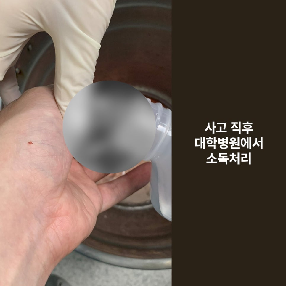 Girin Plastic Surgery for Finger Laceration Suturing, Skin Grafts, and Scar Care image 3