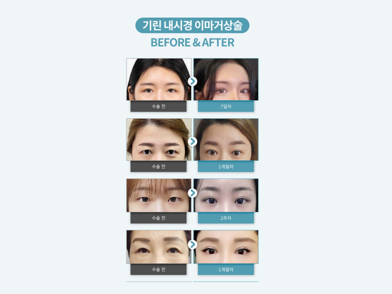 이마거상수술 주름을 개선하는 관련 이미지 9