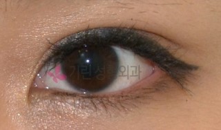 쌍꺼풀아웃라인도 비절개눈매교정으로 관련 이미지 3