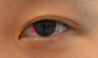 쌍꺼풀수술 일주일 붓기 >> 수술당일, 5일째, 일주일째 쌍수붓기 관련 이미지 1