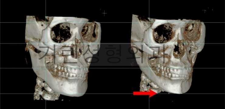 어제 재수술한 환자분의 3DCT입니다. 관련 이미지 3