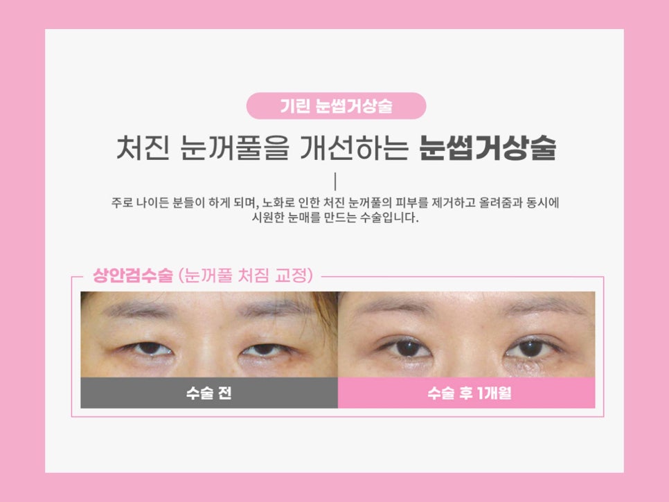처진눈수술 눈매를 바꾸는 방법 관련 이미지 11