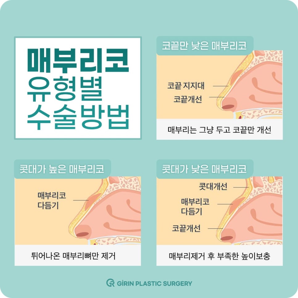 코성형잘하는곳? 강남 기린성형외과를 찾는 이유는 OOO이다 관련 이미지 7