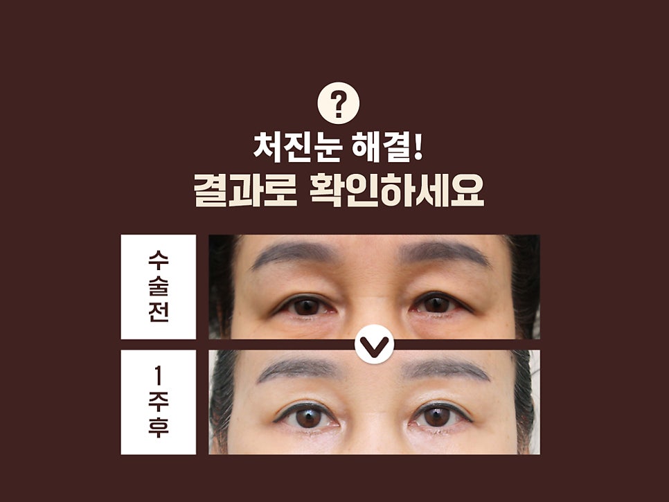 상안검수술회복기간 확인하자 관련 이미지 12