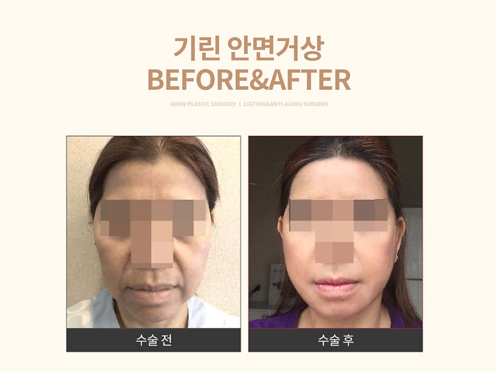 안면거상술잘하는병원 자세히 알아본다면 관련 이미지 16