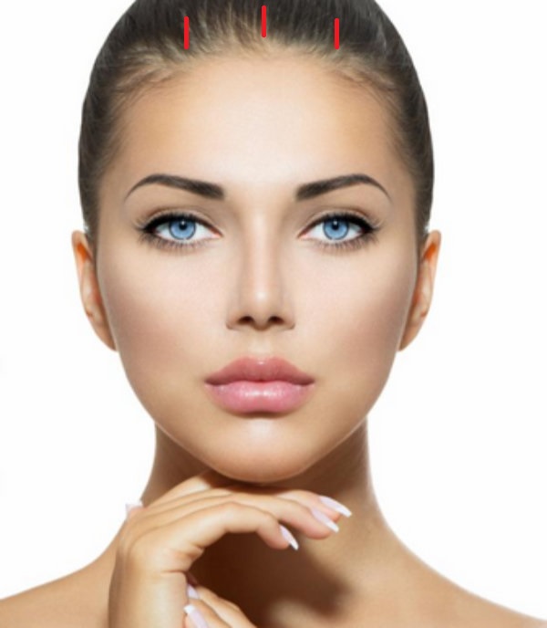 [공유] "이마거상술" 실제 수술은 어떻게 진행되나요? 관련 이미지 4