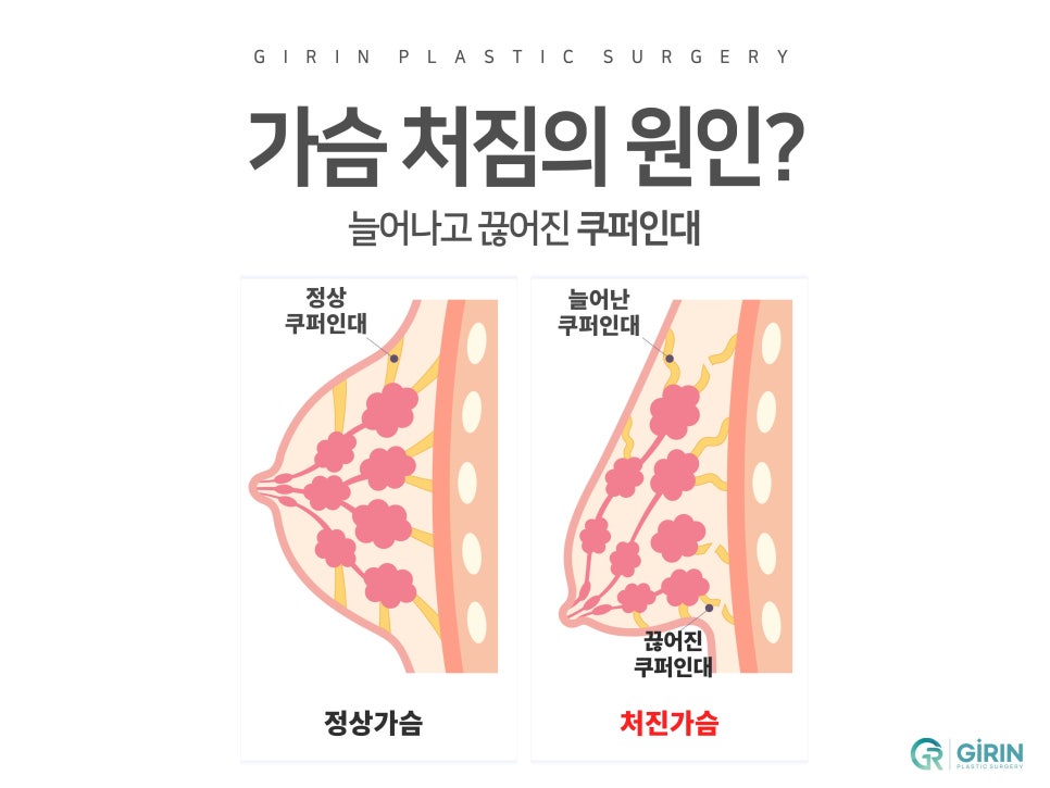 가슴거상술 흉터에 대한 걱정은 관련 이미지 3