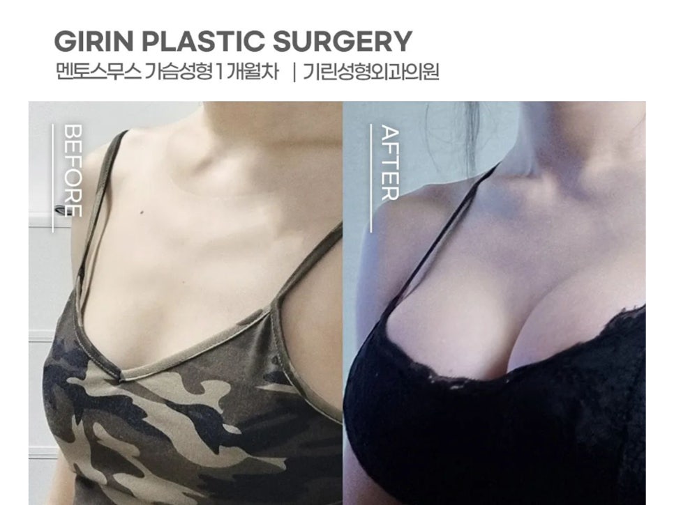 가슴확대수술후기 맞춤으로 알아봐야 관련 이미지 1