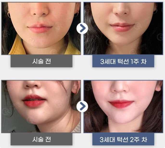 강남지방분해주사, 의미 없는 유형은? 관련 이미지 5