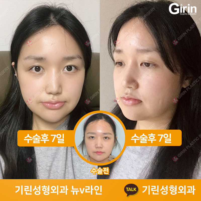 [뉴브이라인] 45도 라운딩 브이라인 절골술로 작은 얼굴 만들기 관련 이미지 5