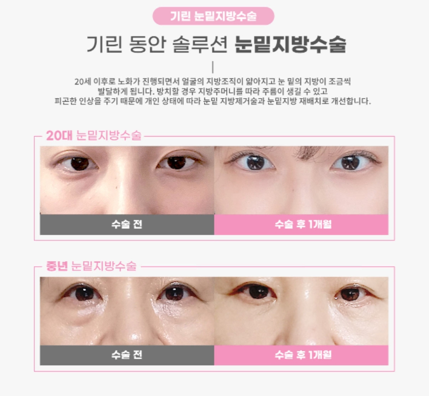 눈밑지방제거수술 하안검 선택의 폭이 넓어졌어요! 관련 이미지 2