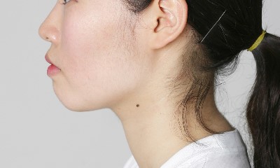 티절골만이 턱끝수술의 답일까? 관련 이미지 4