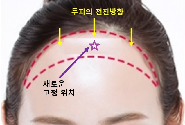 [공유] 이마축소술! 어떤 과정으로 수술하는지 알려드립니다 (안심하세요!) <<수술과정 大해부>> 관련 이미지 10