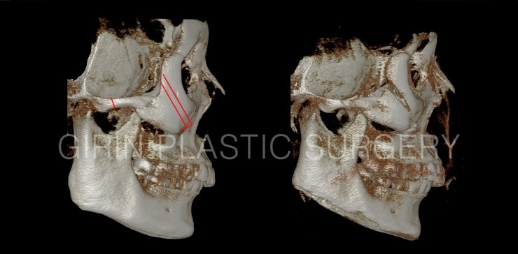 광대축소 불유합과 L절골에 대해 관련 이미지 4