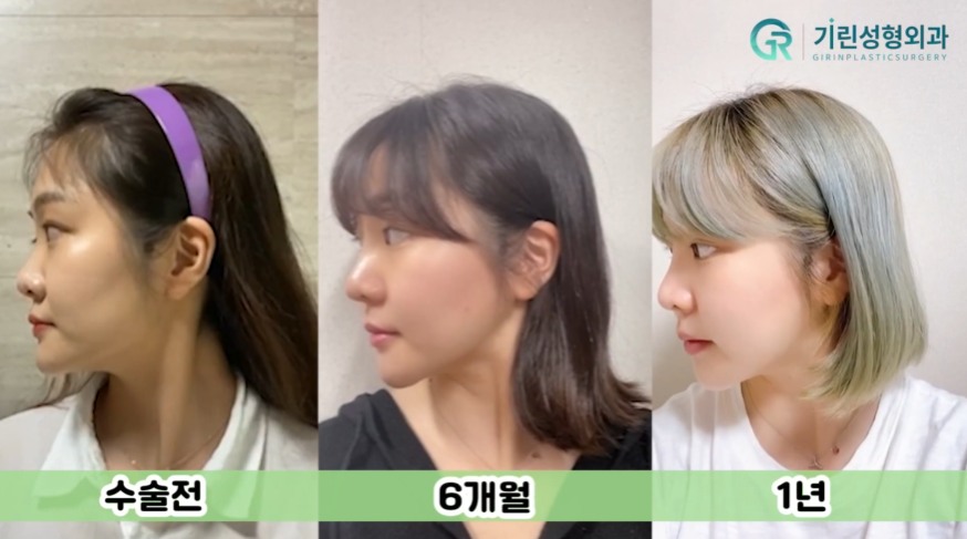 [기린성형외과의원] "카리나가 되고싶어요"_안면윤곽 수술일지 관련 이미지 12