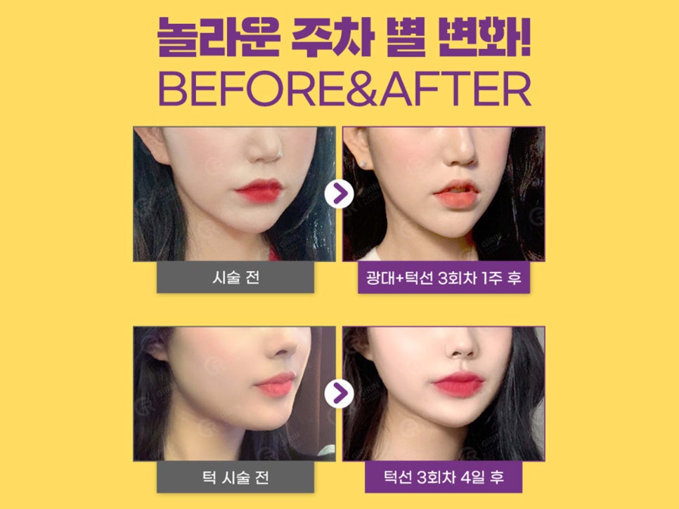 강남윤곽주사 스테로이드 선택도 가능해 관련 이미지 2