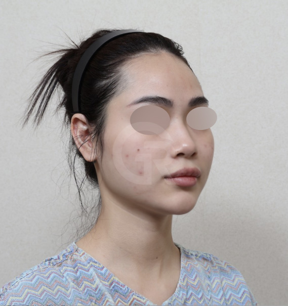 연조직윤곽술, 비대칭을 최소화하는 방법 관련 이미지 3