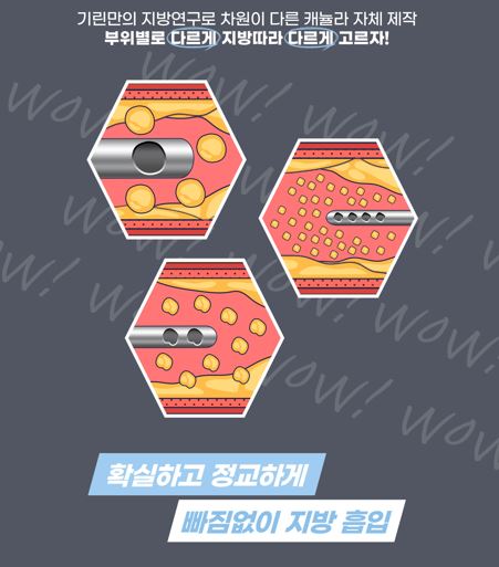 [기린성형외과]팔뚝지방흡입_나도뼈팔될수있을까 관련 이미지 17