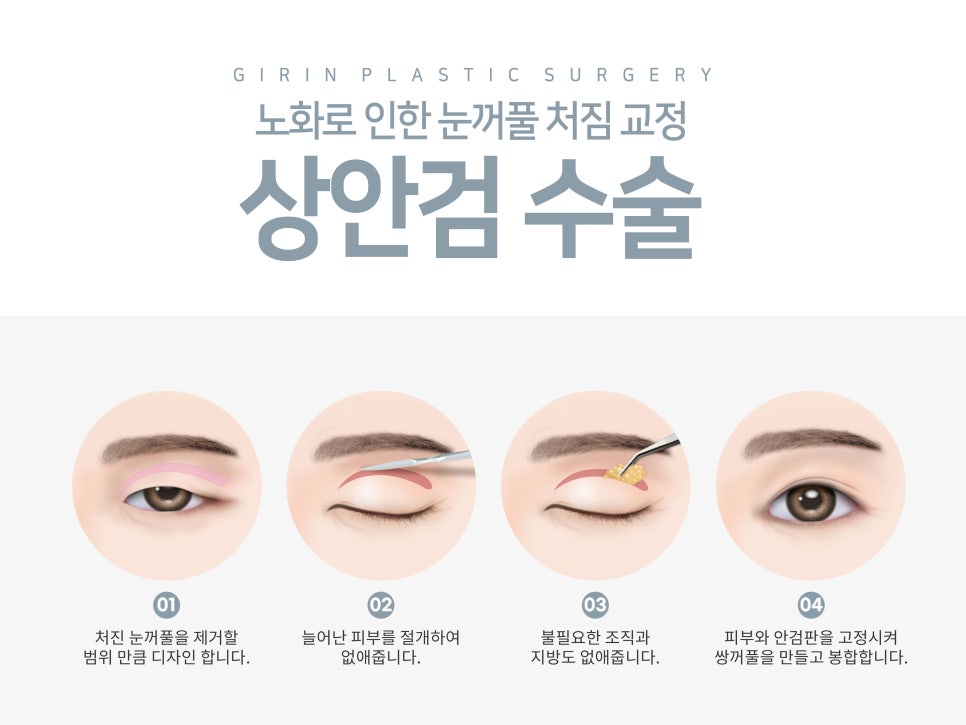 강남눈성형 눈매 개선 만족스럽게 관련 이미지 5
