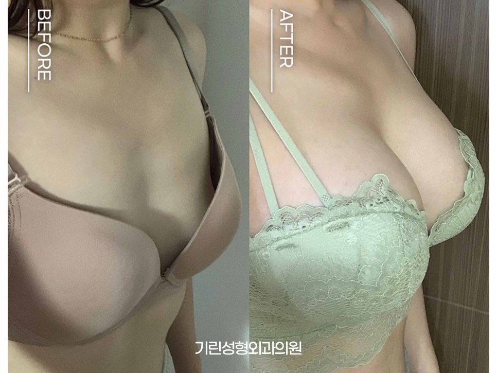 멘토가슴성형 다른 점이 무엇일까? 관련 이미지 10