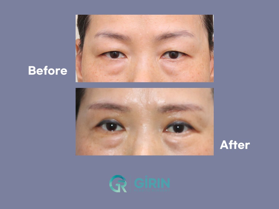 중년눈성형잘하는곳 찾았다면 관련 이미지 2
